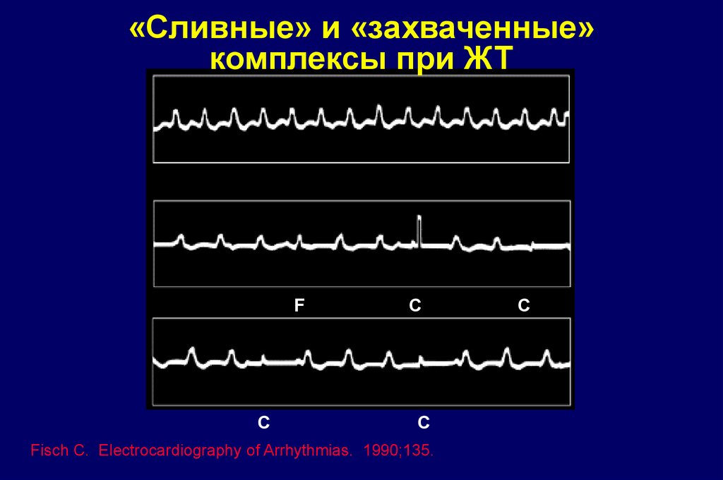 сливные комплексы на экг при парасистолии. морфология qrs. сливные комплексы на экг при экс. желудочковые парасистолы на экг. холтеровское мониторирование при трепетании предсердий.