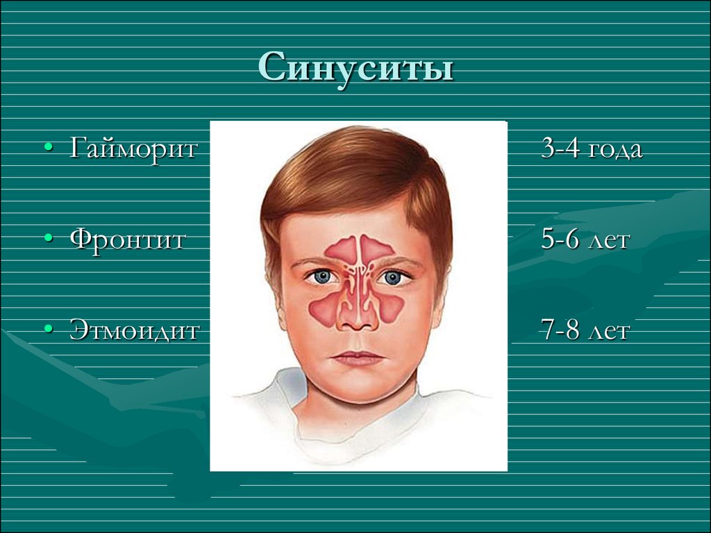 Острый гайморит карта вызова