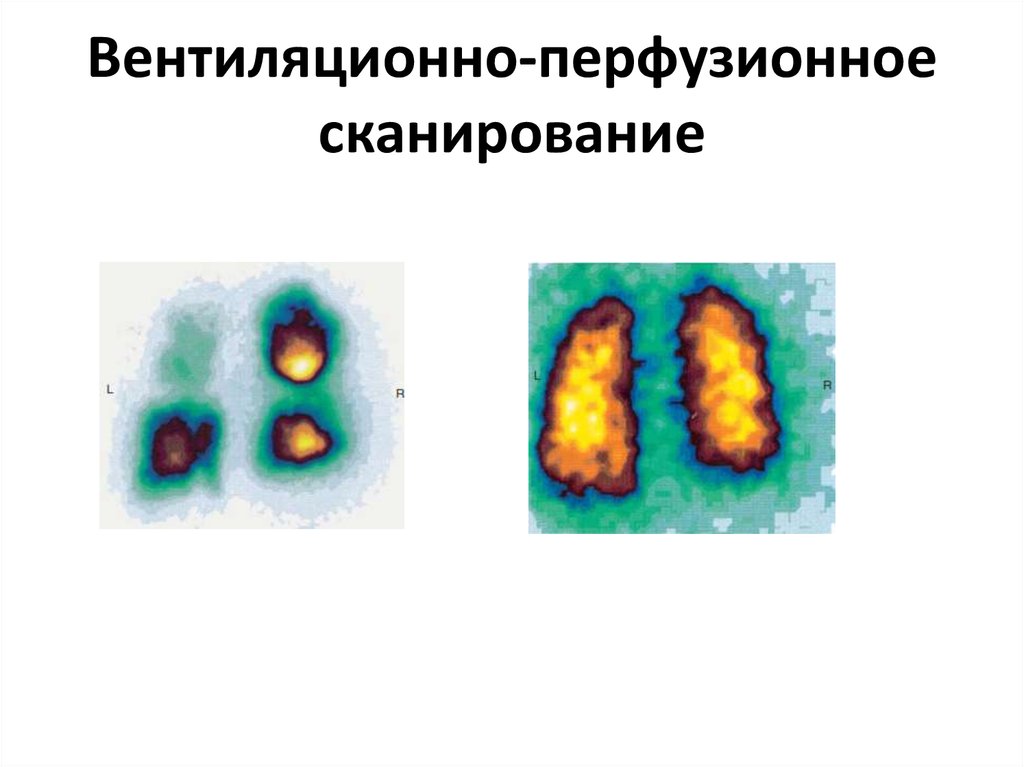 Вентиляционно-перфузионное сканирование
