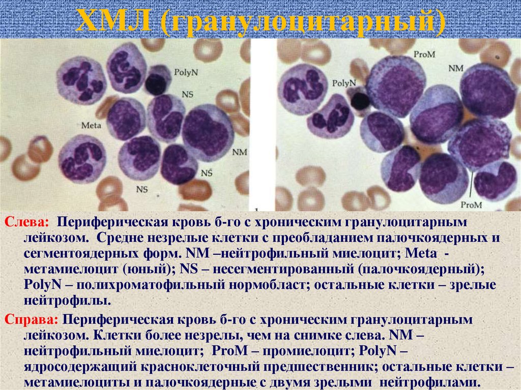 Кровь на б клетки. Хронический миелолейкоз морфология крови. Хронический гранулоцитарный лейкоз. Хронический миелоидный лейкоз мазок крови. Стадийность хронического гранулоцитарного лейкоза.