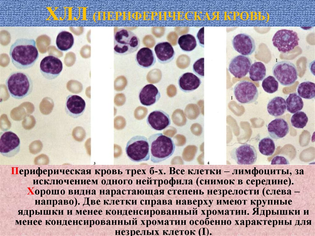 Хр лимфолейкоз картина крови