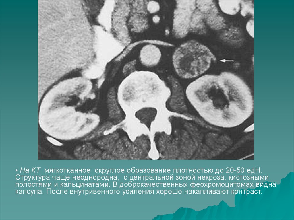 Туберкулез надпочечников. Феохромоцитома надпочечника мрт. Феохромоцитома надпочечника кт контраст. Жировое образование надпочечника кт. Доброкачественные опухоли надпочечника кт.
