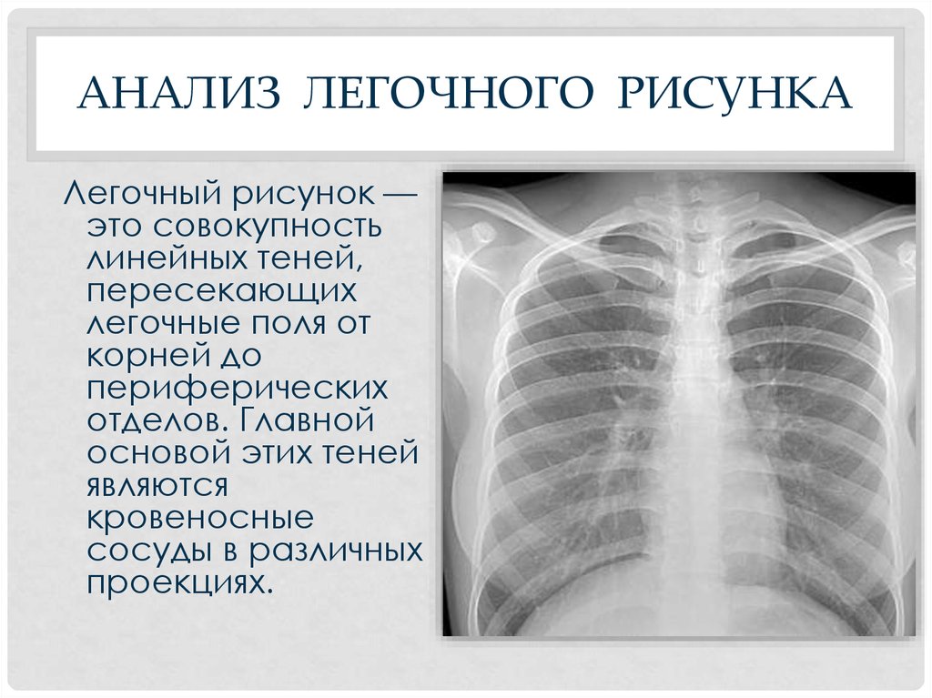 Отделы легочного рисунка. Рентген легких усиление легочного рисунка. Усиление легочного рисунка на рентгене. Легочный рисунок усилен. Легочный рисунок усилия.