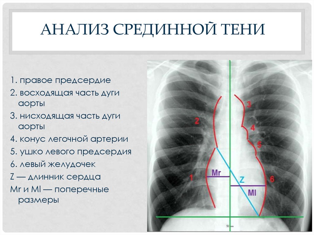 Прямая и боковая проекция. Срединная тень на рентгенограмме. Дуги сердца на рентгенограмме. Срединная тень на рентгенограмме легких. Описание срединной тени на рентгенограмме.