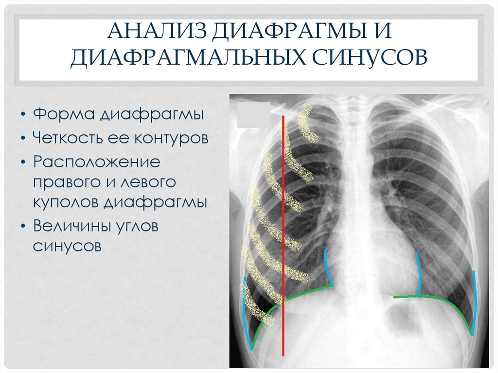 Синусы рентген. Диафрагмальные синусы на рентгенограмме. Синусы запаяны в легких что это. Реберно-диафрагмальный синус рентген. Диафрагма в норме на рентгенограмме.