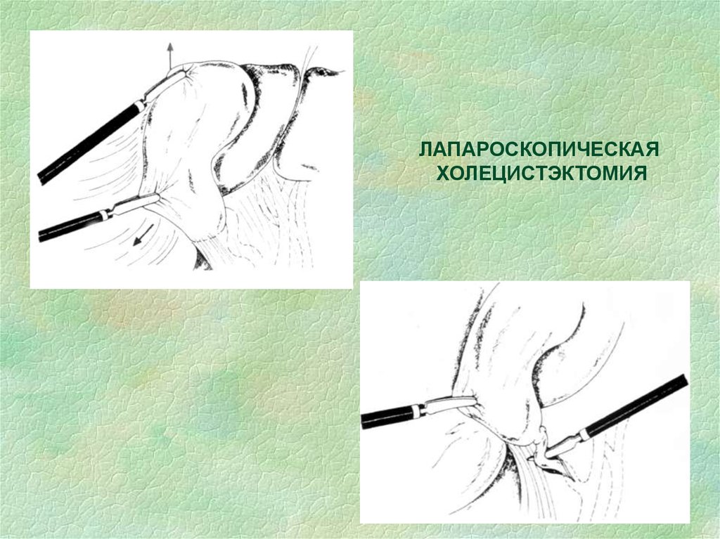 Перенесенная холецистэктомия. Холецистэктомия лапароскопически. Этапы операции холецистэктомии. Лапароскопическая холецистэктомия разрезы. Анатомия холецистэктомия.