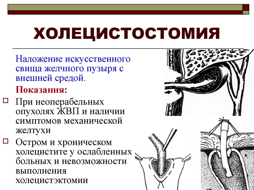 Свищ лечение. Холецистостомия дренаж. Холецистостомия ход операции. Холецистостомия топографическая анатомия. Наружный свищ желчного пузыря.