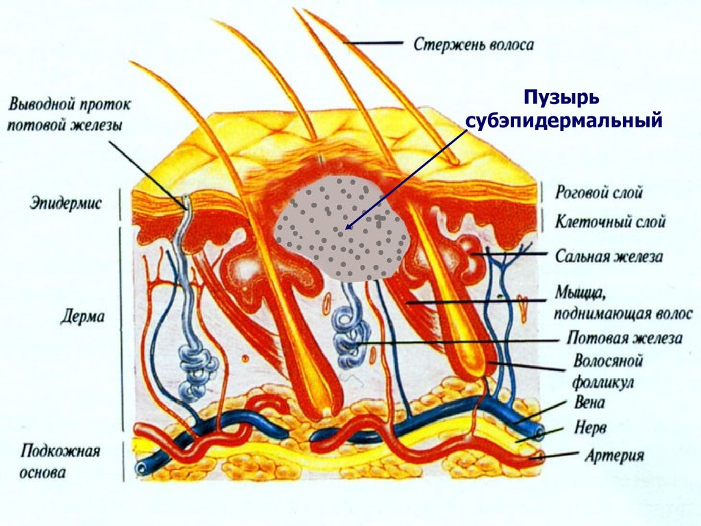 Зона кожи. Субэпидермальный слой. Физиология кожи. Поднимающая волос мышца эпидермис волос потовая железа. Интраэпидермальные пузыри.