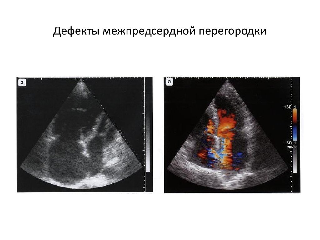Дефекты перегородок. Дефект межпредсердной перегородки на ЭХОКГ. УЗИ сердца с дефектом межжелудочковой перегородкой.