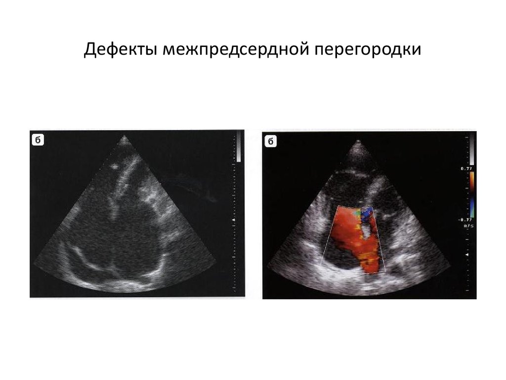 Операция межпредсердной перегородки. Пороки межпредсердной перегородки ЭХОКГ. Сетчатый дефект межпредсердной перегородки.