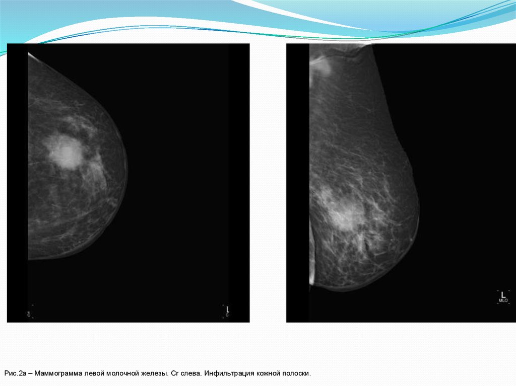 Центр маммограммы. Маммограмма. Маммограмма молочных желез. Сглевой молочной железы. CR левой молочной железы.