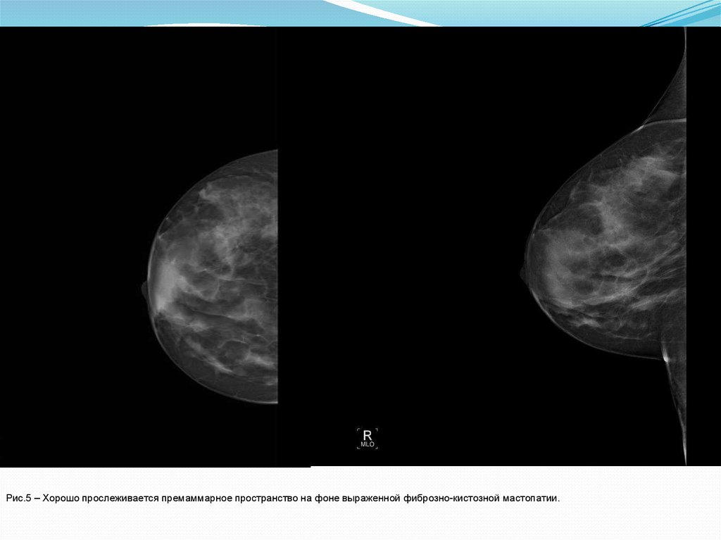 Маммография фкм. Фиброзно-кистозная мастопатия на кт. Премаммарноей пространство. Премаммарное пространство в молочной железе что это. Премаммарное пространство в молочной железы рентген.