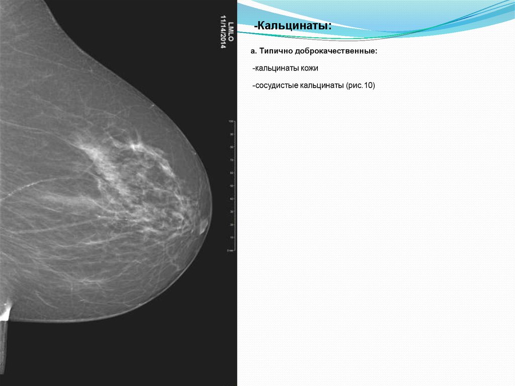Кальцинат железы. Сосудистые кальцинаты. Доброкачественные кальцинаты.