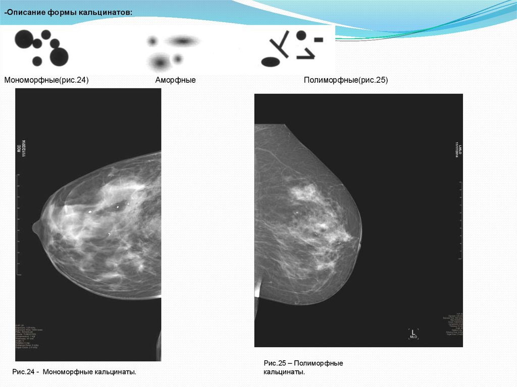 Округлые кальцинаты. Маммография микрокальцинаты. Кальцинаты на маммографии. Кальцинаты молочной железы на маммографии. Мономорфные кальцинаты.