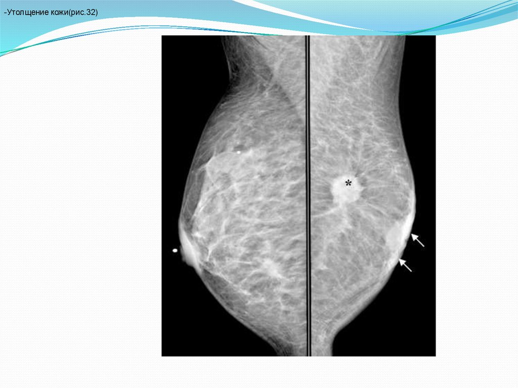 Гиперплазированные лимфоузлы. Интрамаммарный лимфоузел на маммографии. Лимфоузлы молочной железы маммография. Жировой некроз маммография. Интрамаммарный лимфоузел молочной железы на УЗИ.