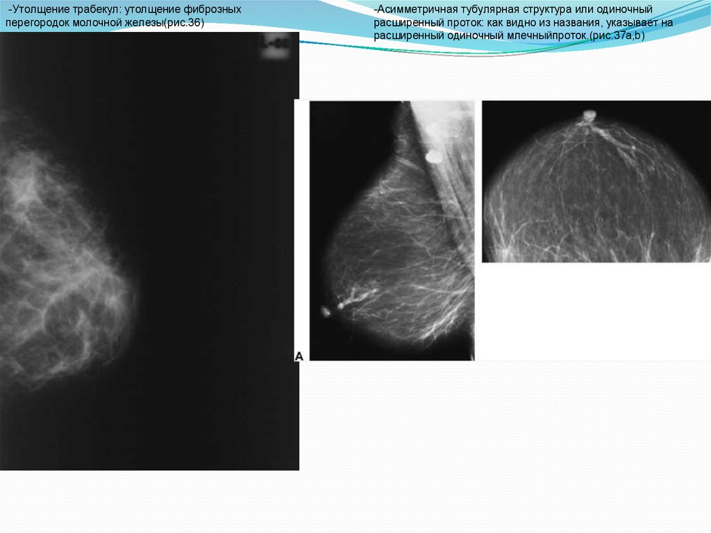 Тубулярная форма молочных желез. Расширенный проток молочной железы. Расширены протоки в молочной железе. Локальное расширение протоков молочной железы. Увеличенный проток молочной железы.