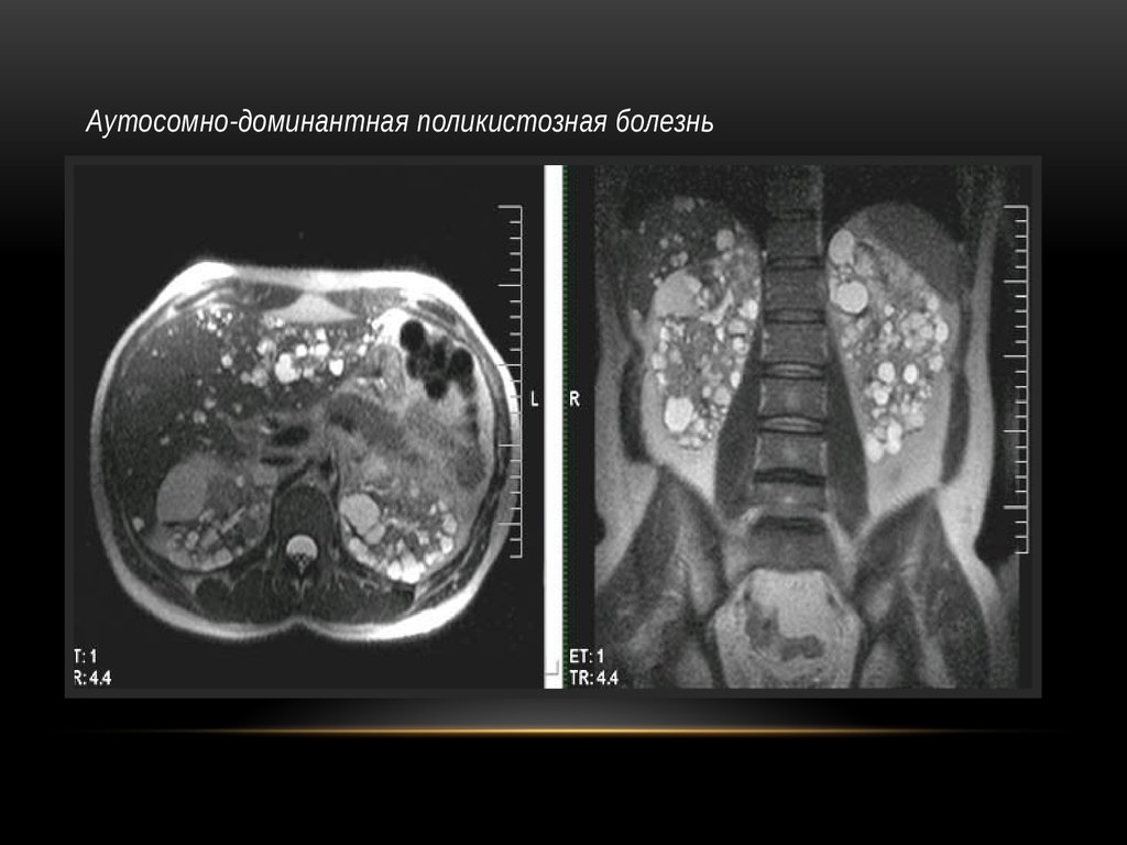 Мрт почек. Мультикистоз почки мрт. Киста надпочечника мрт.