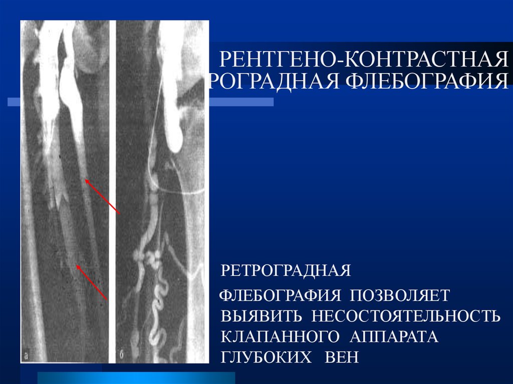 Перфорантная несостоятельность голени. Флебография вен нижних конечностей варикоз. Ретроградная бедренная флебография. Рентгеноконтрастная флебография вен нижних конечностей. Дистальная и проксимальная флебография.