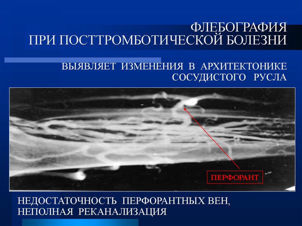 Изменение обнаружено. Посттромботическая болезнь патогенез. Флебография посттромботической болезни. Посттромботические изменения вен. Посттромботическая болезнь формы.