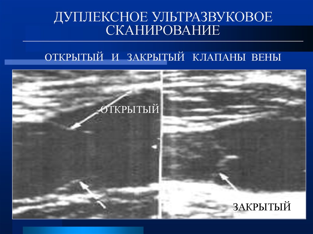 Вены нижних конечностей уздг. УЗИ глубоких вен нижних конечностей.