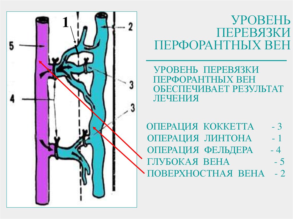 Недостаточность клапанов нижних конечностей