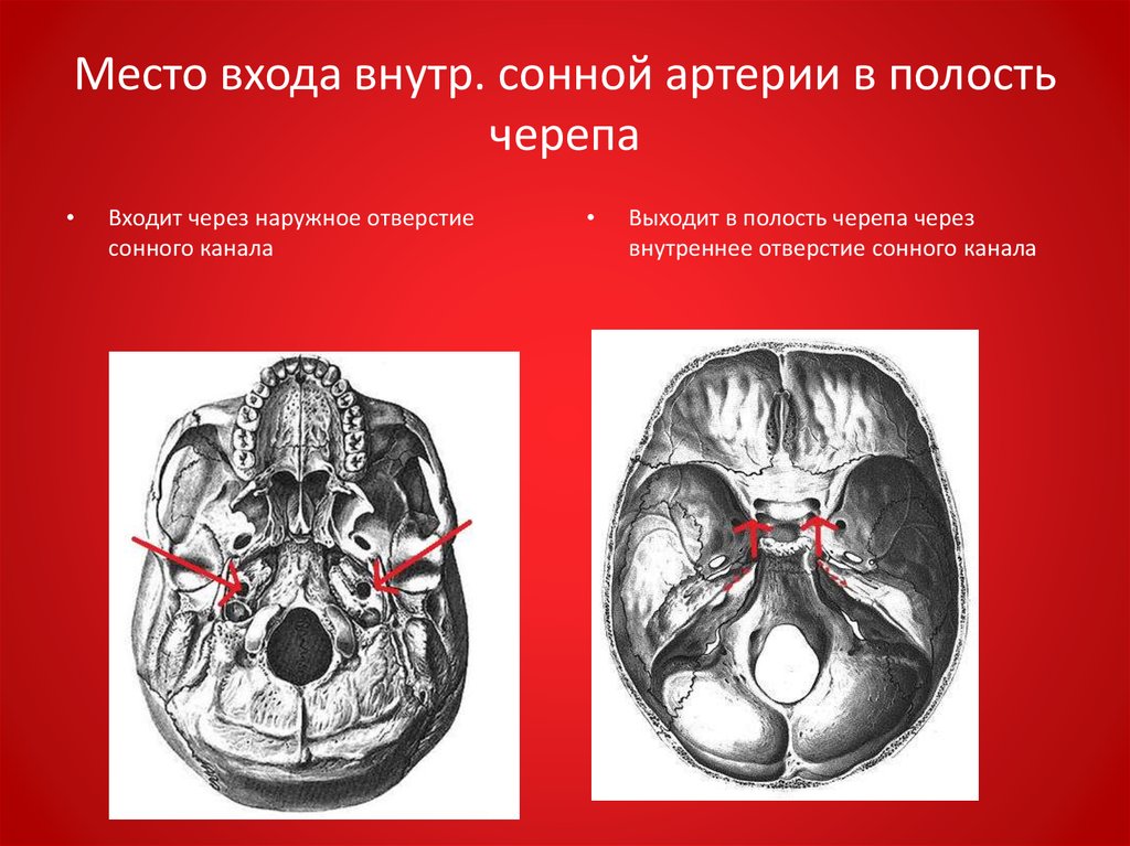 Проникающая в полость черепа. Внутренняя Сонная артерия входит в полость черепа через отверстие. Артерии основания черепа. Отверстие канала внутренней сонной артерии. Наружное и внутреннее отверстие сонного канала.