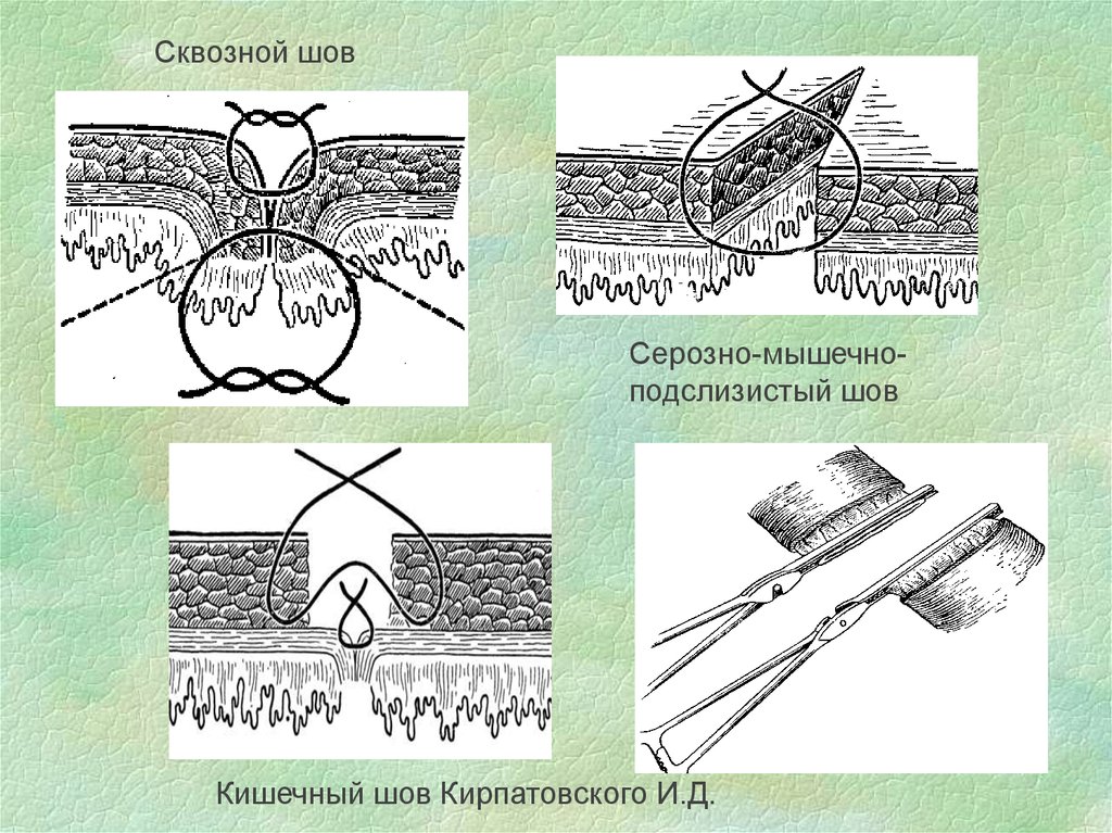 Кишечные швы. Сквозные непрерывные кишечные швы. Кишечный сквозной шов Шмидена. Серозно мышечный кишечный шов.