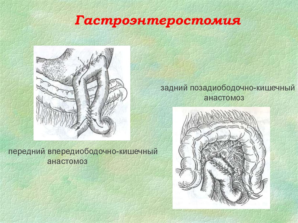 Операция желудка кишечника. Задняя позадиободочная гастроэнтеростомия. Задний позадиободочный анастомоз. Задний желудочно кишечный анастомоз. Гастроэнтеростомия по Брауну.