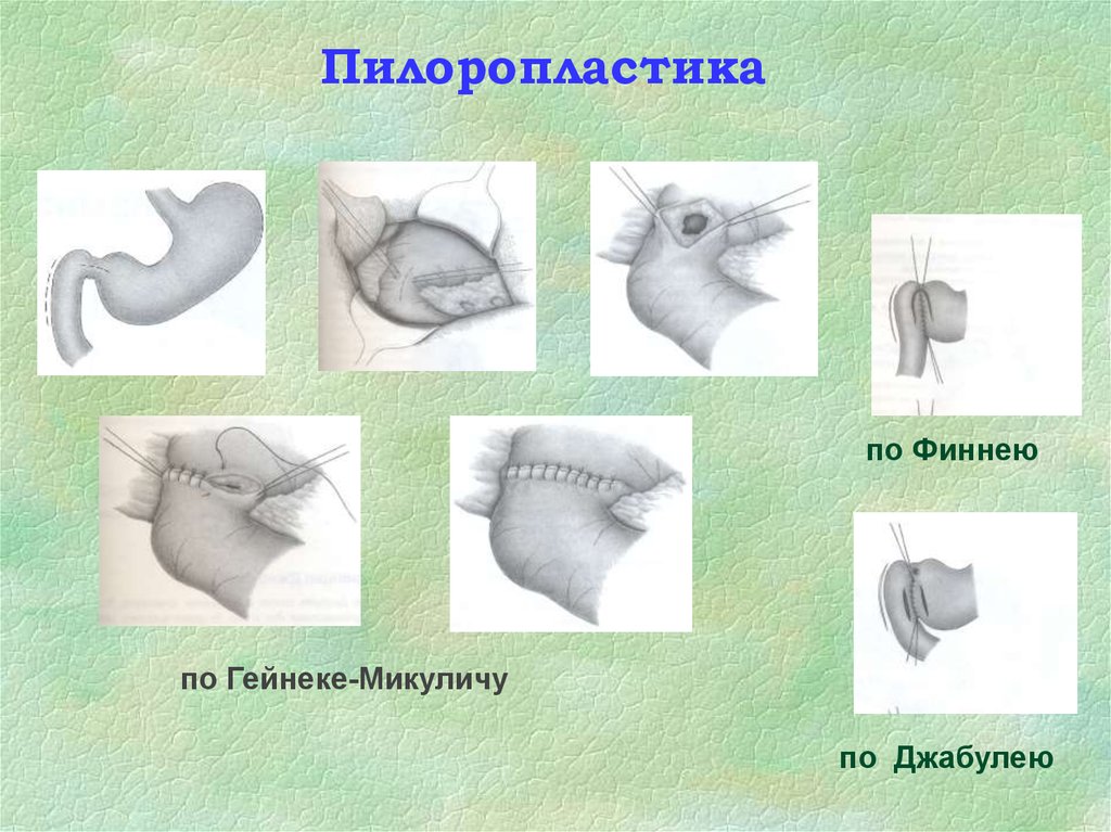 Пилоропластика по финнею схема