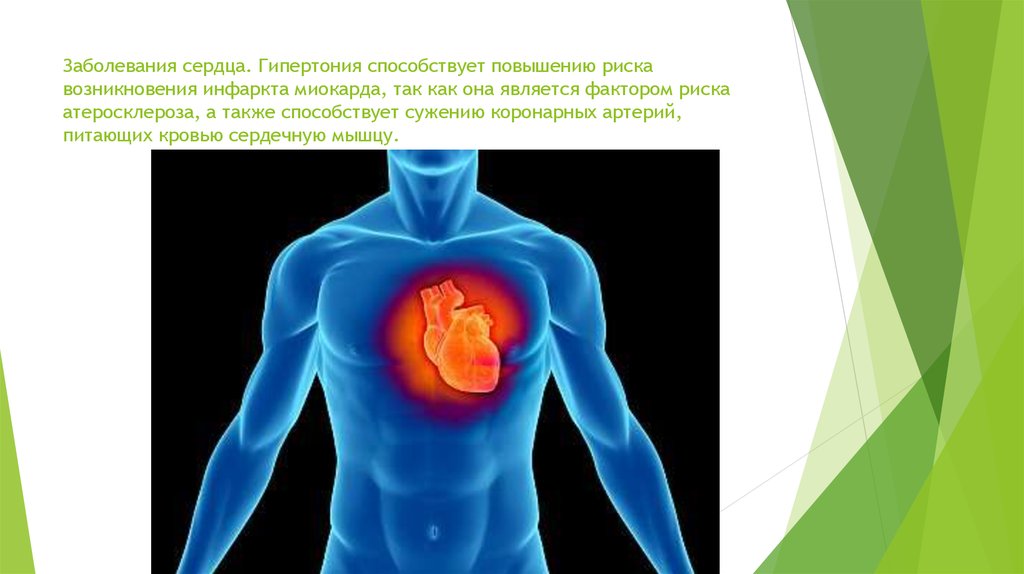 Заболевания сердца. Гипертония способствует повышению риска возникновения инфаркта миокарда, так как она является фактором