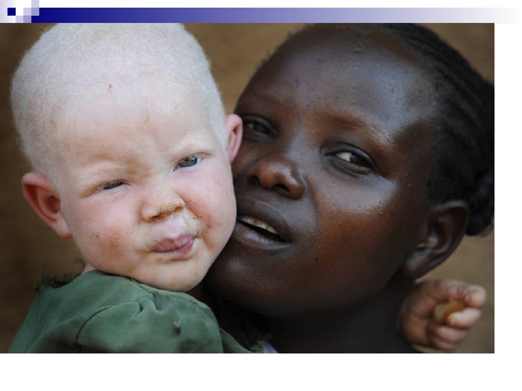 Глазокожный альбинизм Тип 3. Альбинос негроидной расы. Альбинизм негроидная раса. Как называют чернокожих