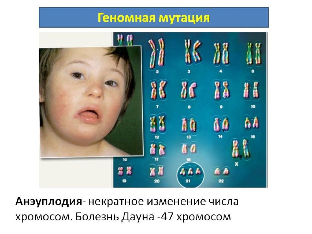 Синдром дауна лишняя хромосома. Синдром Дауна геномная мутация. Геномные и хромосомные заболевания. Хромосомные заболевания синдром Дауна. Хромосомные мутации болезни.