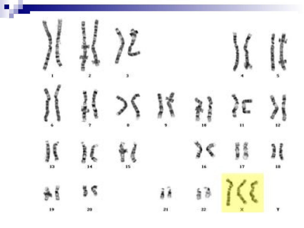 Фото трипло. Полисомия кариотип. Синдром трисомии х хромосомы. Полисомия по х-хромосоме кариотип. Синдром трипло-х кариотип.