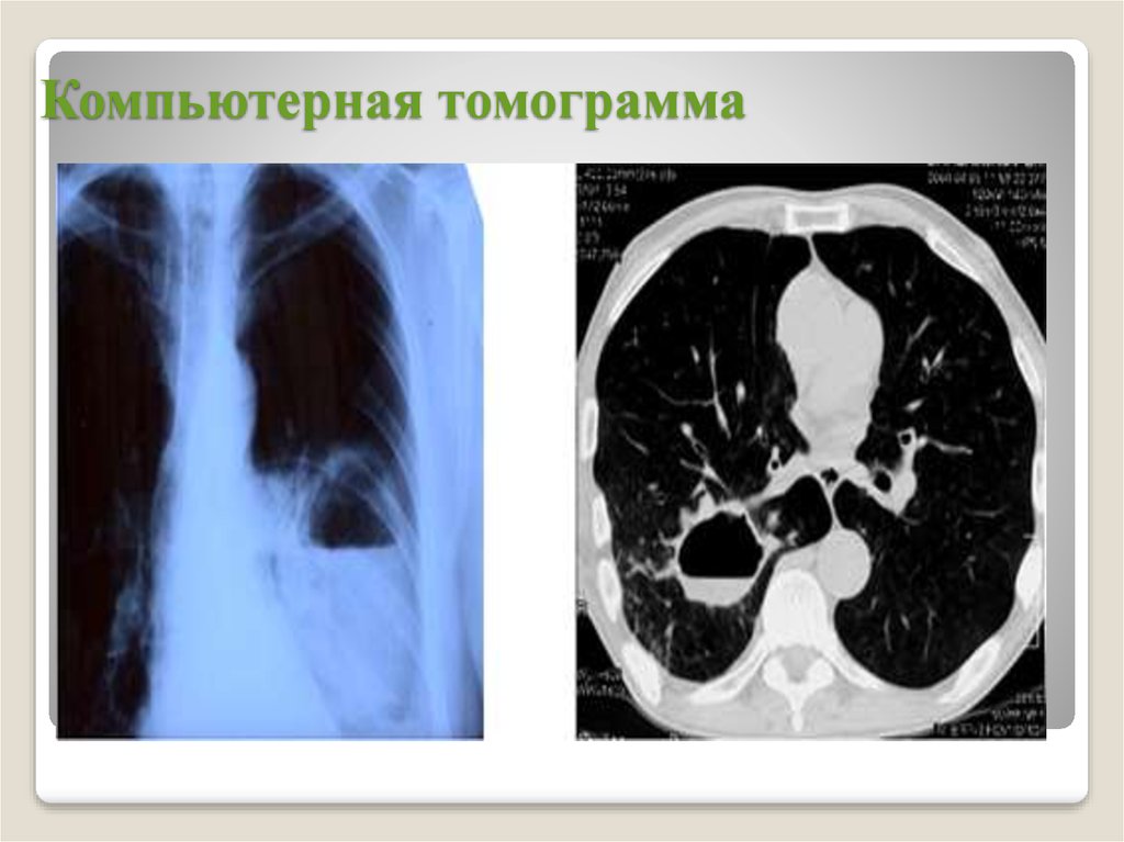 Кт легких презентация