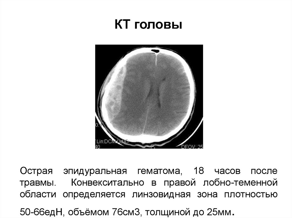 Организующая гематома