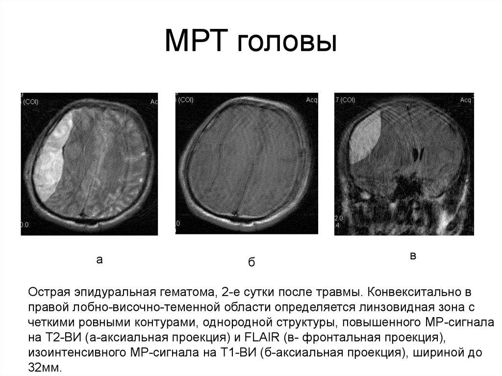 Эпидуральная гематома на кт