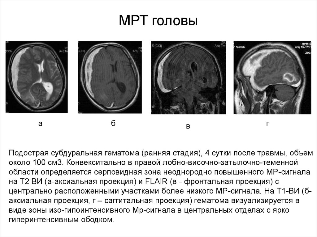 Кт при сотрясении головного мозга