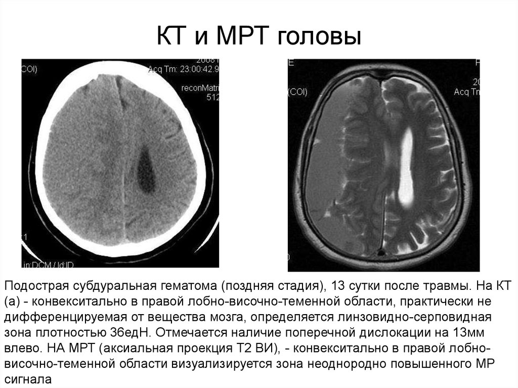 После мрт. Конвекситальная субдуральная гематома. Подострая субдуральная гематома кт. Субдуральная гематома в лобной кт. Подострая эпидуральная гематома на кт.