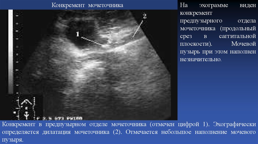 Узи картина мочекаменной болезни