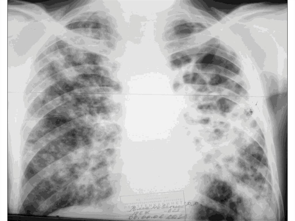 Как выглядят легкие при туберкулезе фото