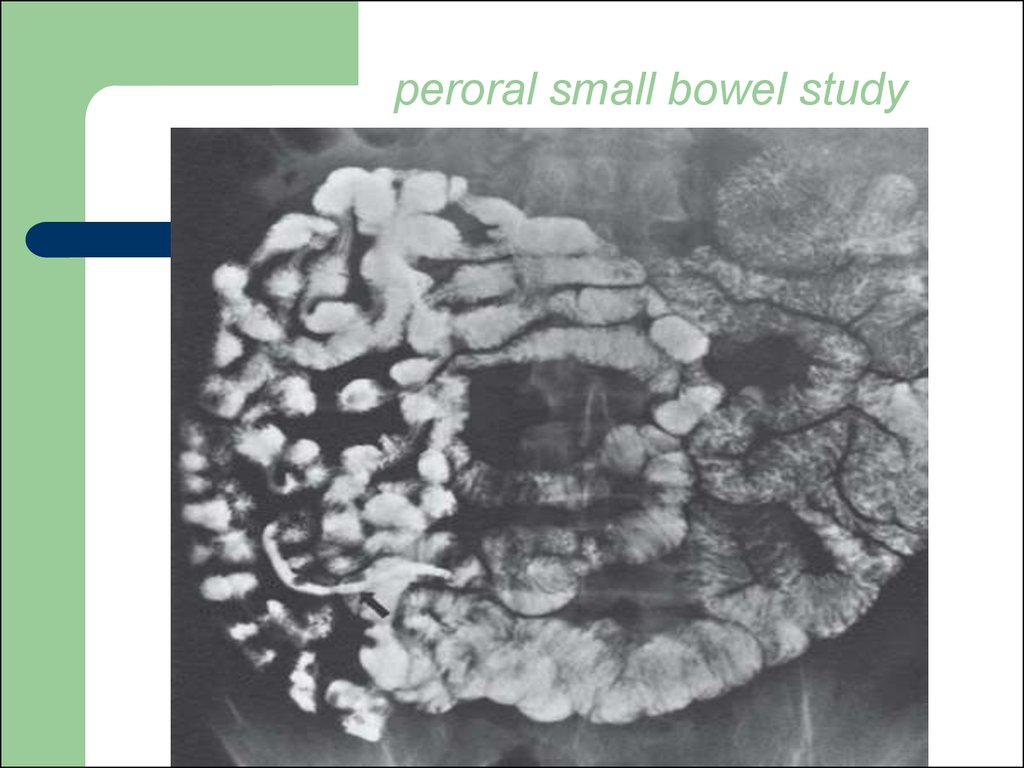 peroral small bowel study
