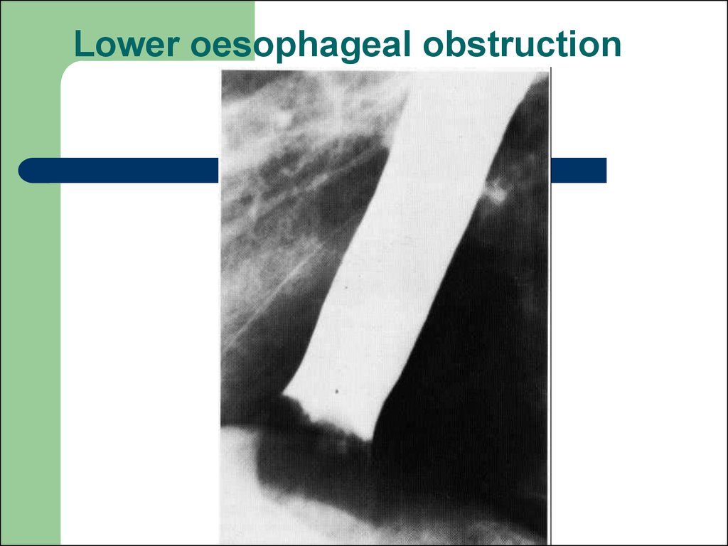 Lower oesophageal obstruction
