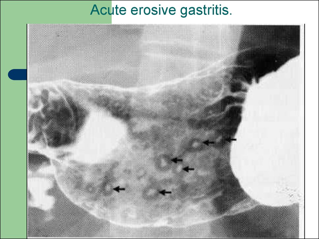 Acute erosive gastritis.