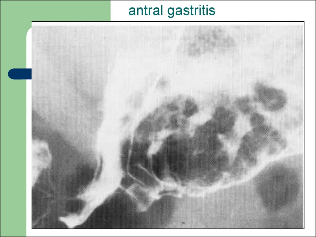 antral gastritis