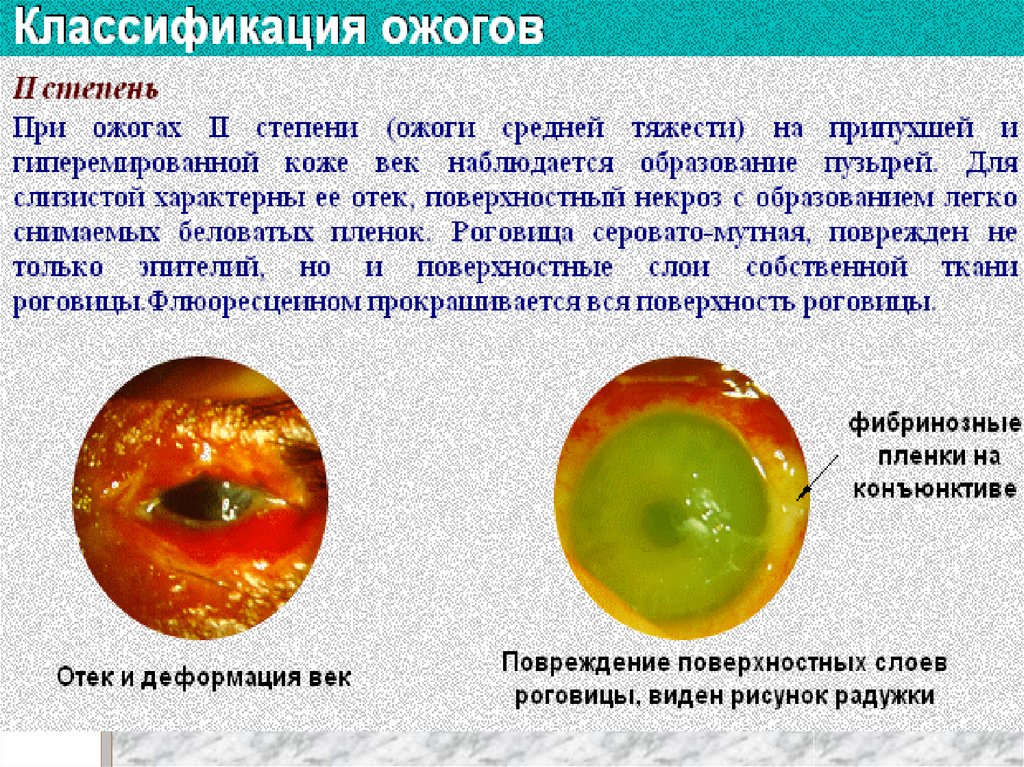 Что делать при термическом ожоге глаза