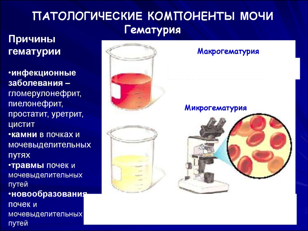 Нарушения мочи. Макрогематурия и микрогематурия. Гематурия. Моча с примесью крови.