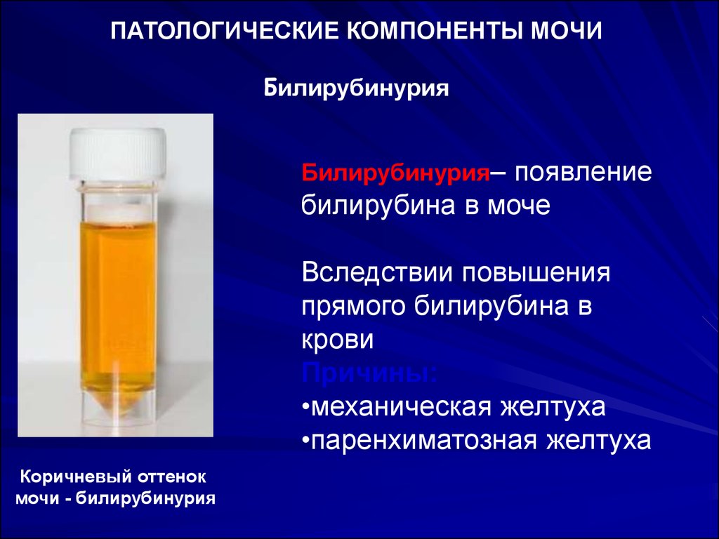 Повышение прямого. Билирубин в моче. Билирубин цвет мочи. Билирубинурия. Причинытпоявления в моче билируьина.