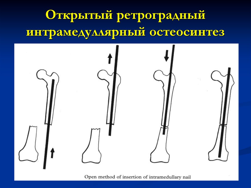 Операции на костях. Интрамедуллярный (внутрикостный) остеосинтез. Интрамедуллярный остеосинтез бедренной кости техника. Антероградный и ретроградный остеосинтез. Антеградный интрамедуллярный остеосинтез бедра.