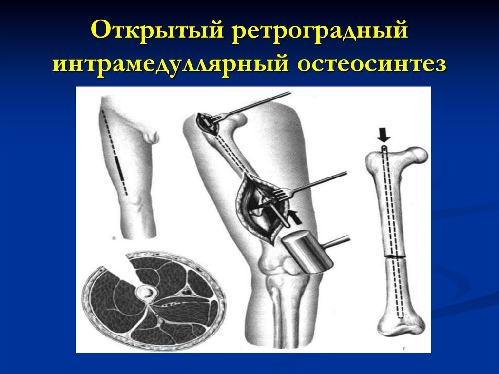 Открытая репозиция костей