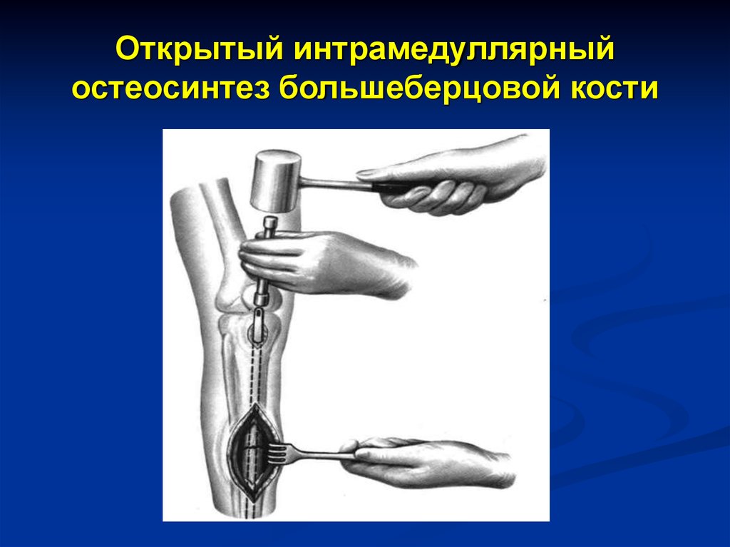 Операции на костях. Интрамедуллярный (внутрикостный) остеосинтез. Интрамедуллярный металлоостеосинтез. Блокируемый интрамедуллярный остеосинтез. Интрамедуллярный остеосинтез динамизация.
